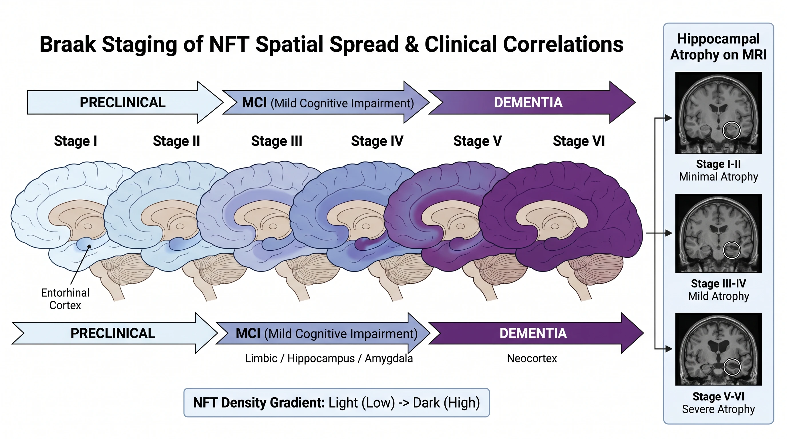 Braak staging diagram showing NFT spread across six stages from entorhinal cortex through hippocampus to neocortex, correlated with clinical severity (Figure generated with SciFig)